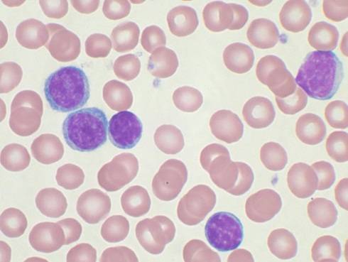 leucemia linfoblastica acuta